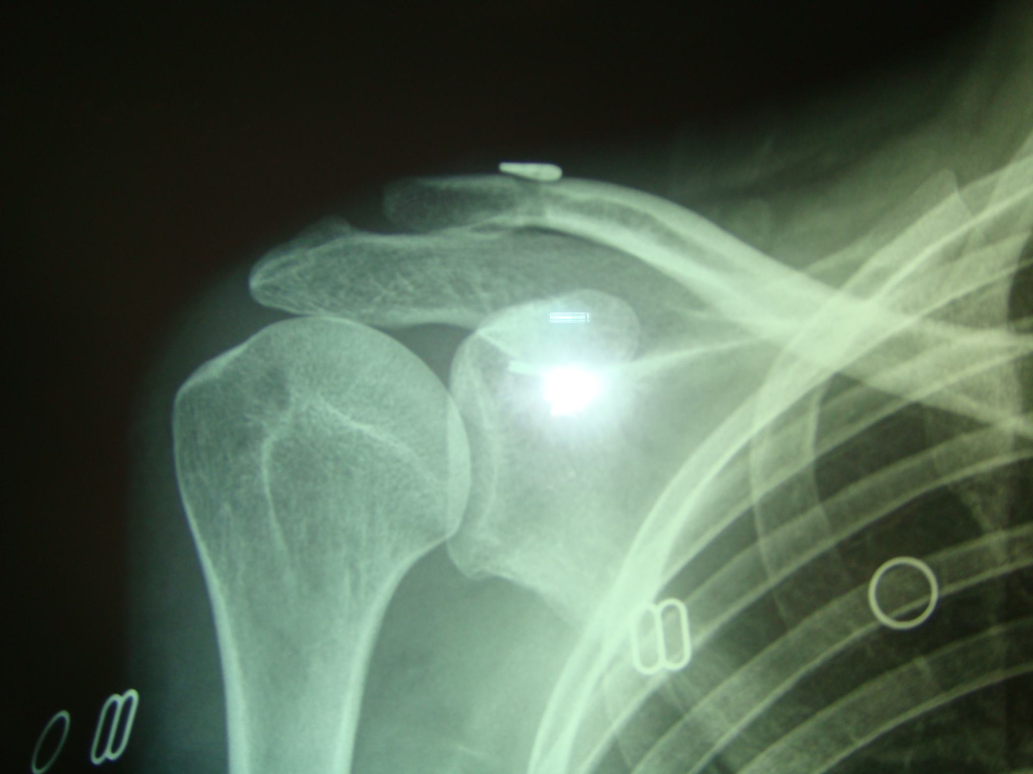 acromioclavicularDislocation5