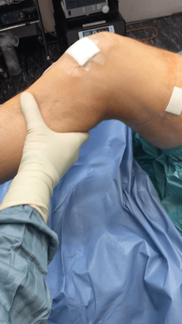 anteriorCruciateLigamentInjury5