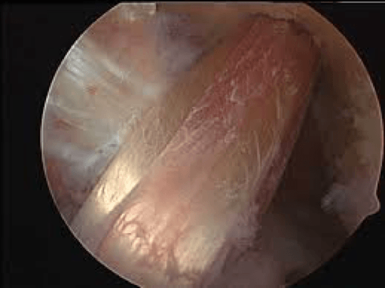 anteriorCruciateLigamentInjury4