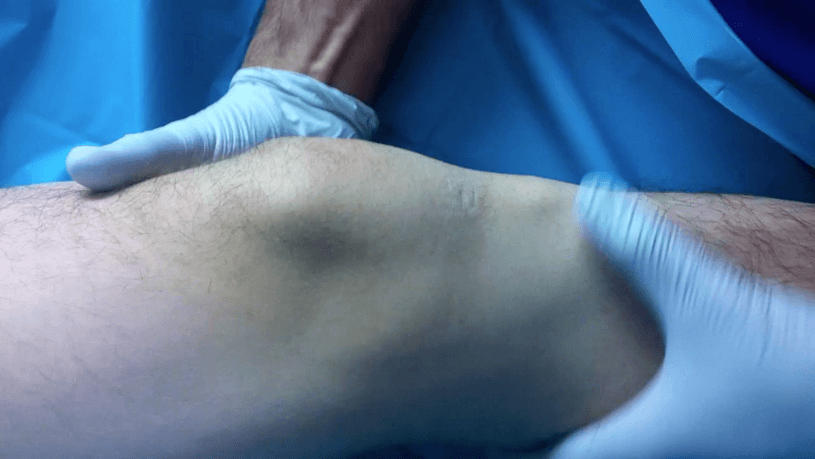 anteriorCruciateLigamentInjury2