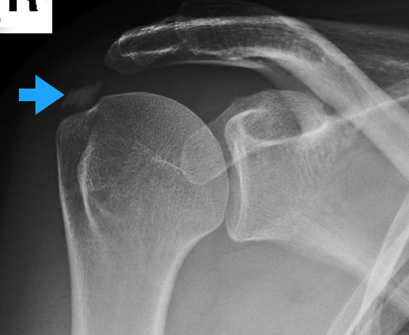 A Review of the Best Shoulder Exercises To Get Rid of Calcific