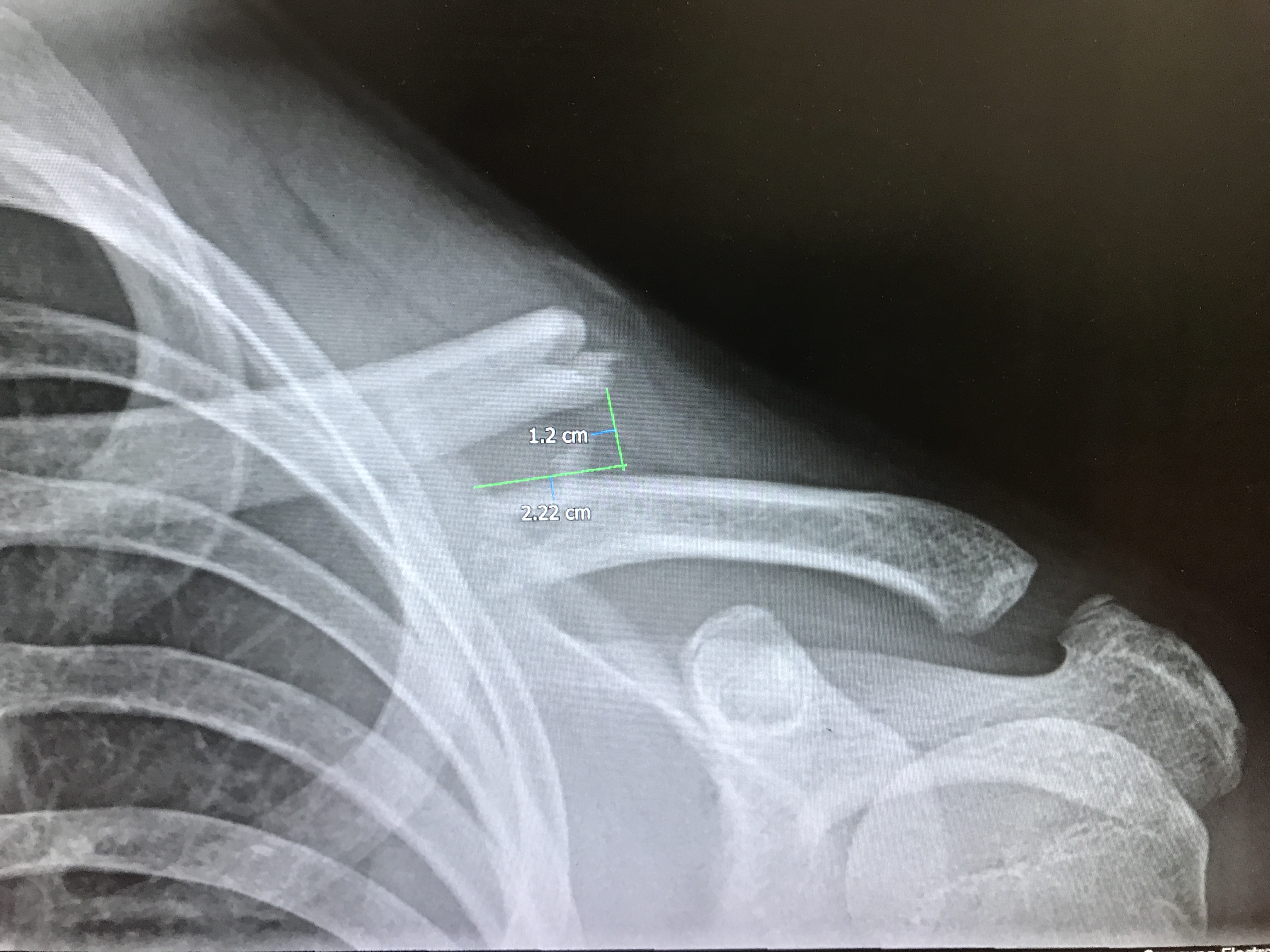 clavicle bone fracture