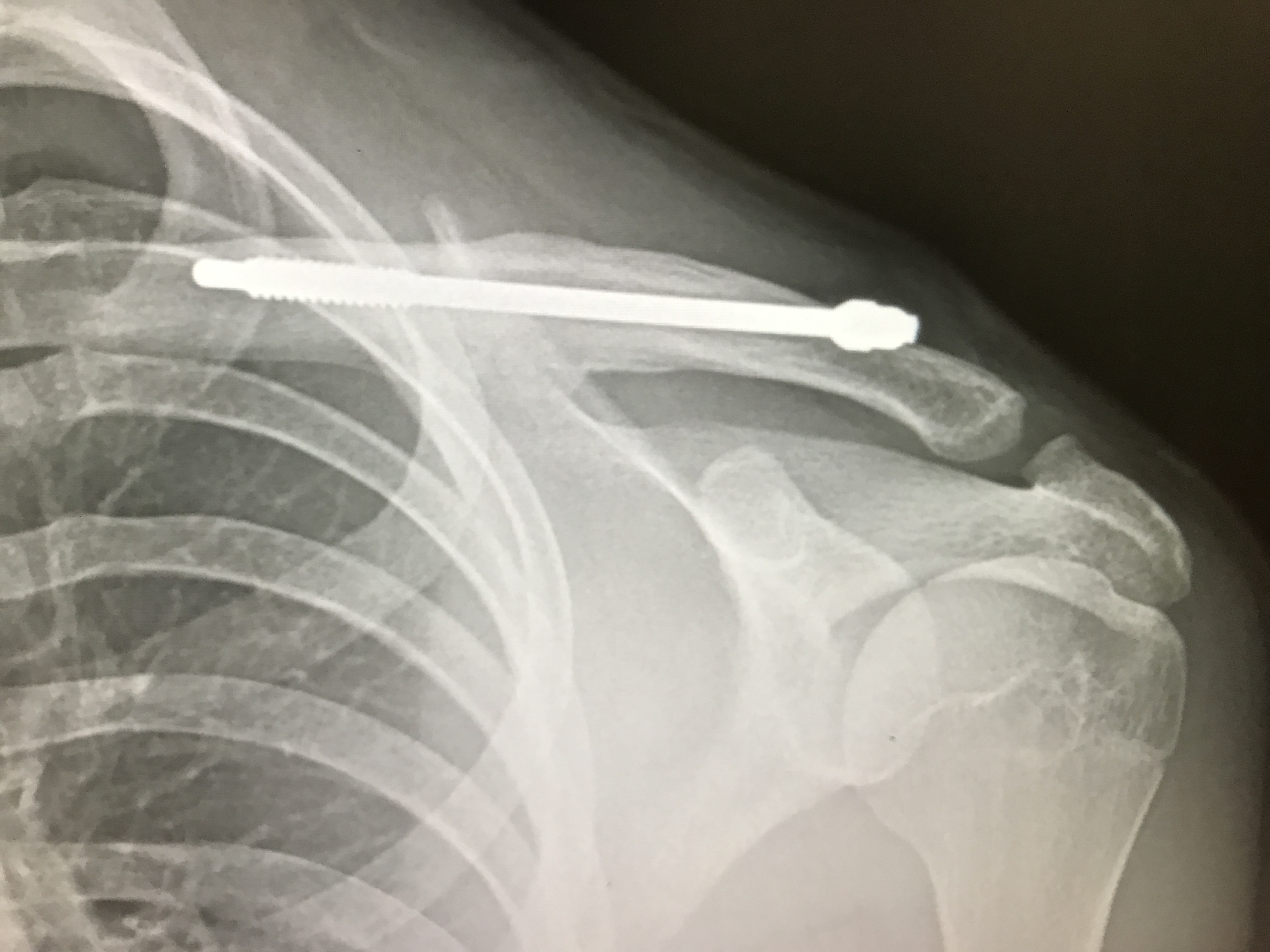 clavicle bone fracture