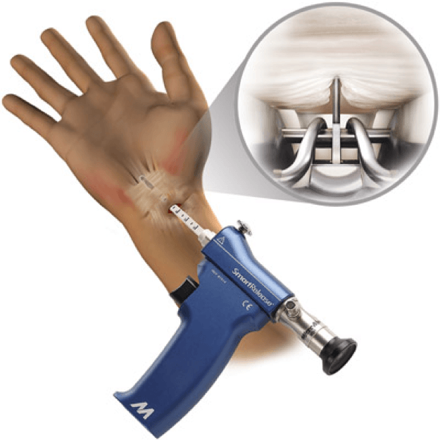 endoscopicCarpalTunnelRelease