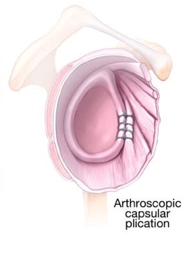 ArticlesContent-keyholeSurgeryForTheTreatmentOfDislocatingShoulder4