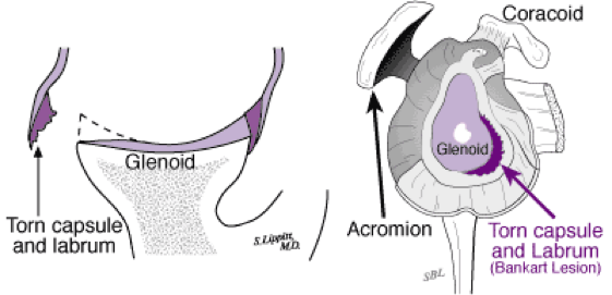 ArticlesContent-keyholeSurgeryForTheTreatmentOfDislocatingShoulder2