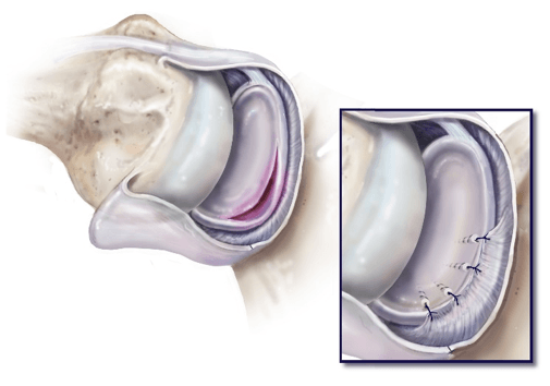 ArticlesContent-keyholeSurgeryForTheTreatmentOfDislocatingShoulder3