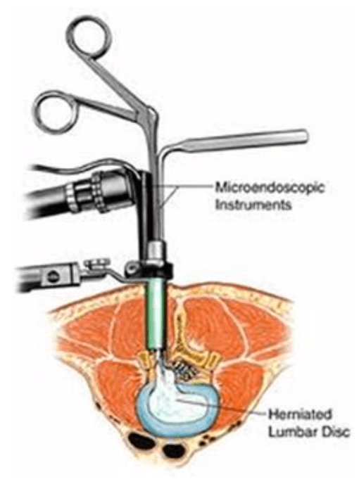 minimallyInvasiveSpineSurgery5