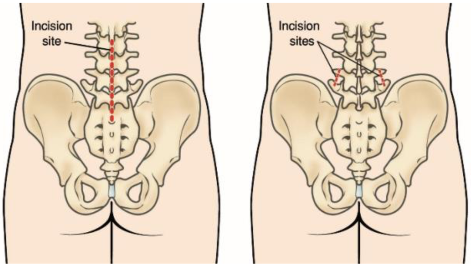 minimallyInvasiveSpineSurgery