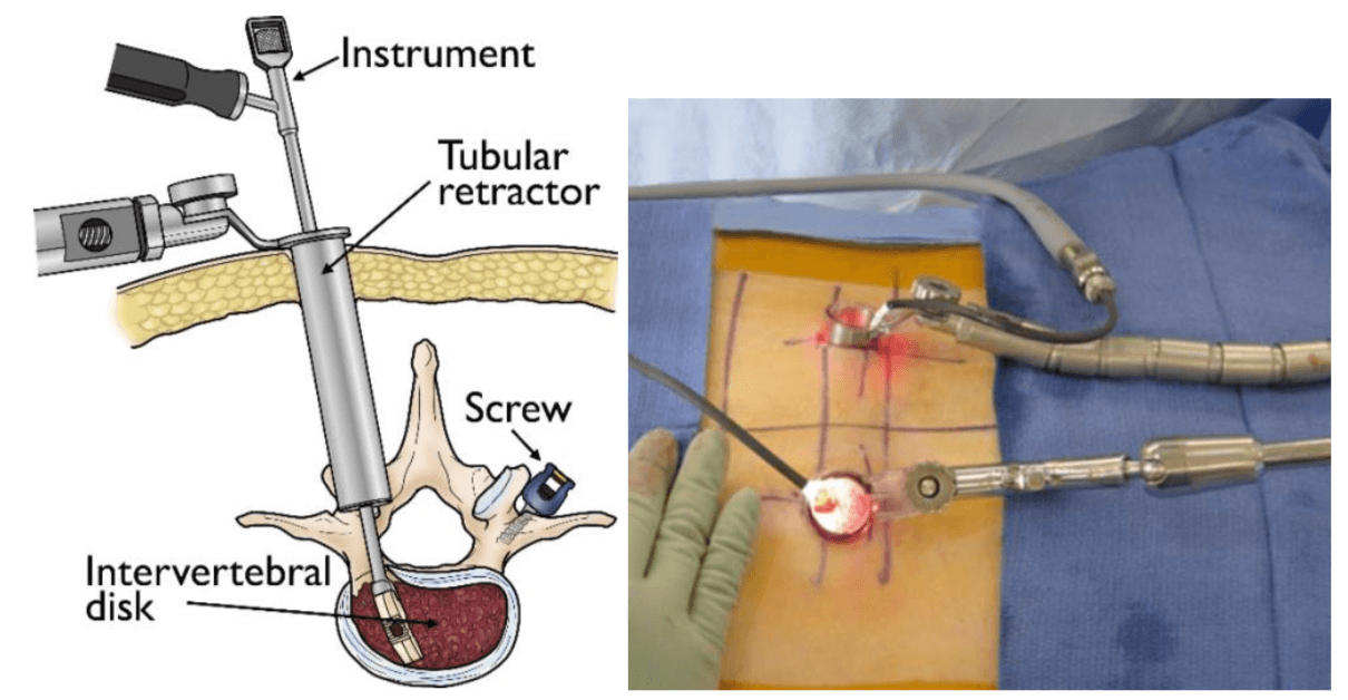 minimallyInvasiveSpineSurgery7