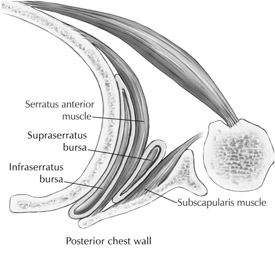 ArticlesContent-scapuloThoracicKeyholeSurgery