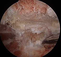 ArticlesContent-scapuloThoracicKeyholeSurgery6