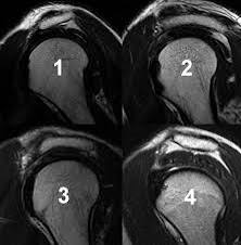 ArticlesContent-subAcromegalyImpingement