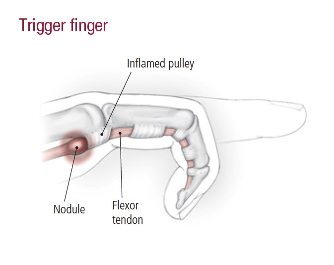 triggerFinger-first1